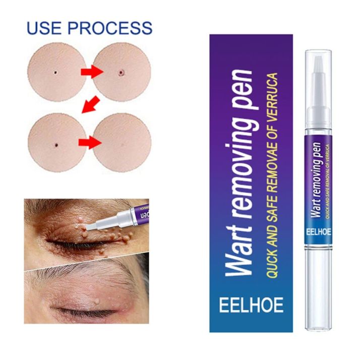 Wart Remover Cream –  Quick & Safe Removal Pen